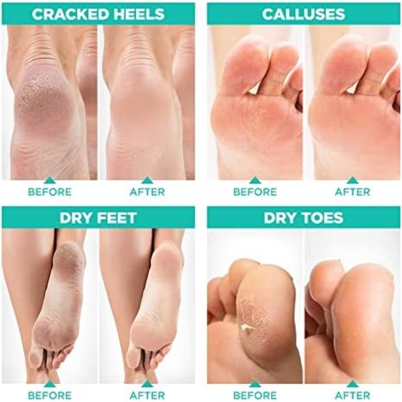 Foot Peel Mask for Dry Cracked Feet - Remove Dead Skin and Calluses - pack of 4 - Picture 3 of 6